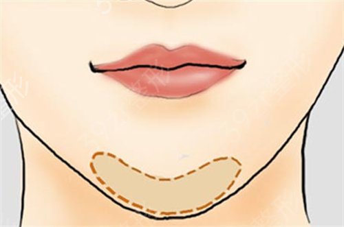 国内下颌角手术权威医生排名如下