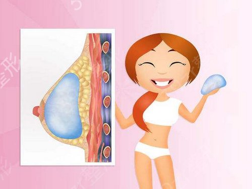 精挑细选的在金华芘丽芙做假体隆胸