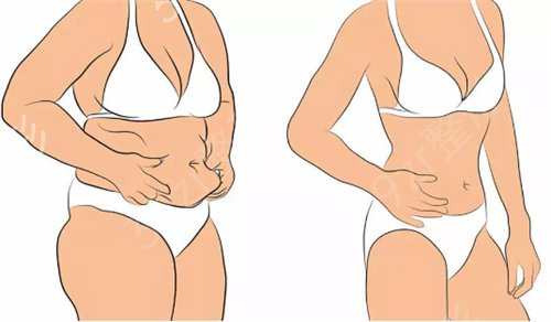 南京吸脂整形哪家好