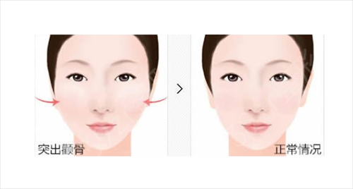 西京医院颧骨内推手术多少钱