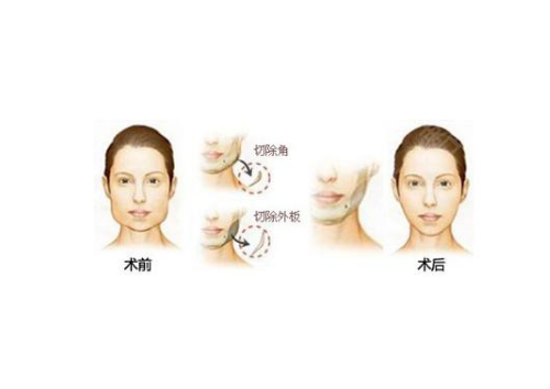 西京医院颧骨内推手术多少钱